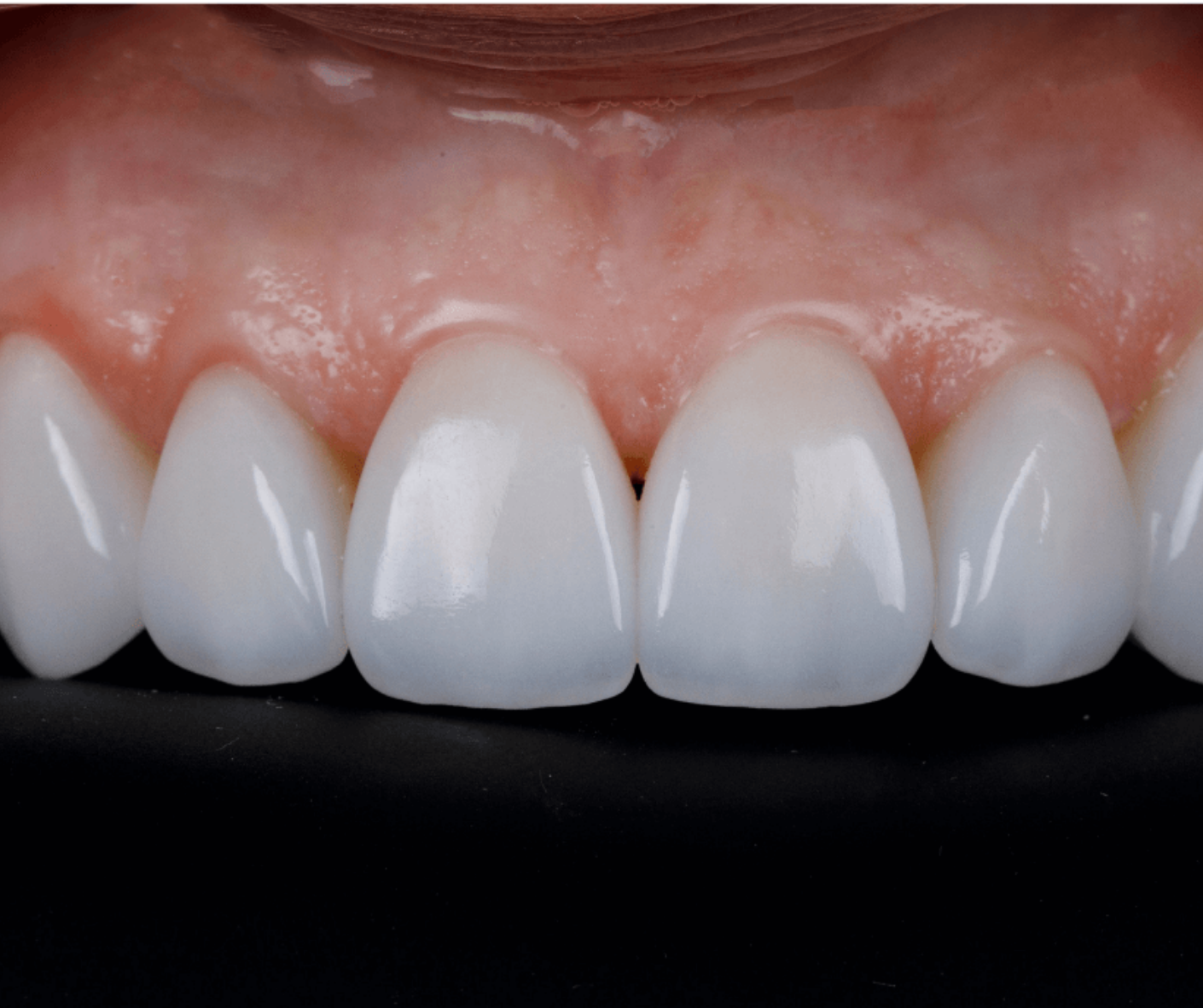 E-Max Crowns/Full Veneers