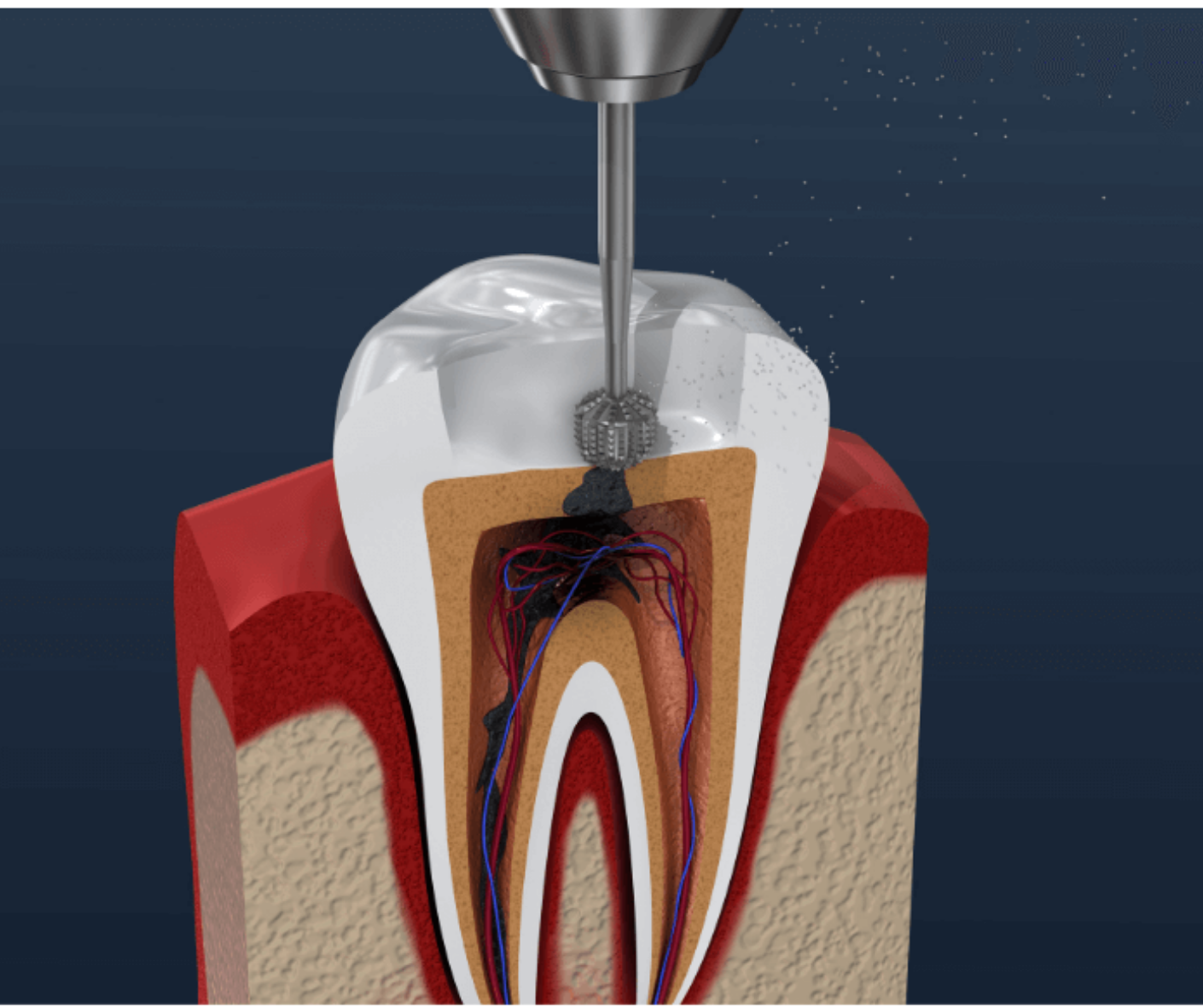 Root Canal Treatment