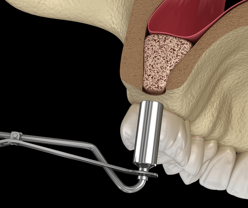 Sinus Lift/Bone Graft