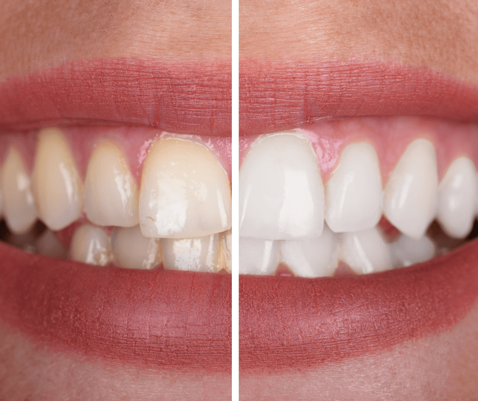 Professional Laser Teeth Whitening