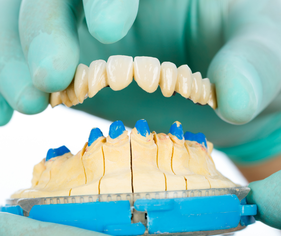 Permanent Dental Bridge